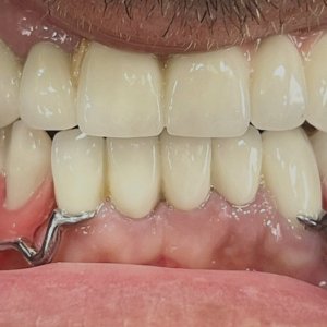 Smile Protez Calisma 1